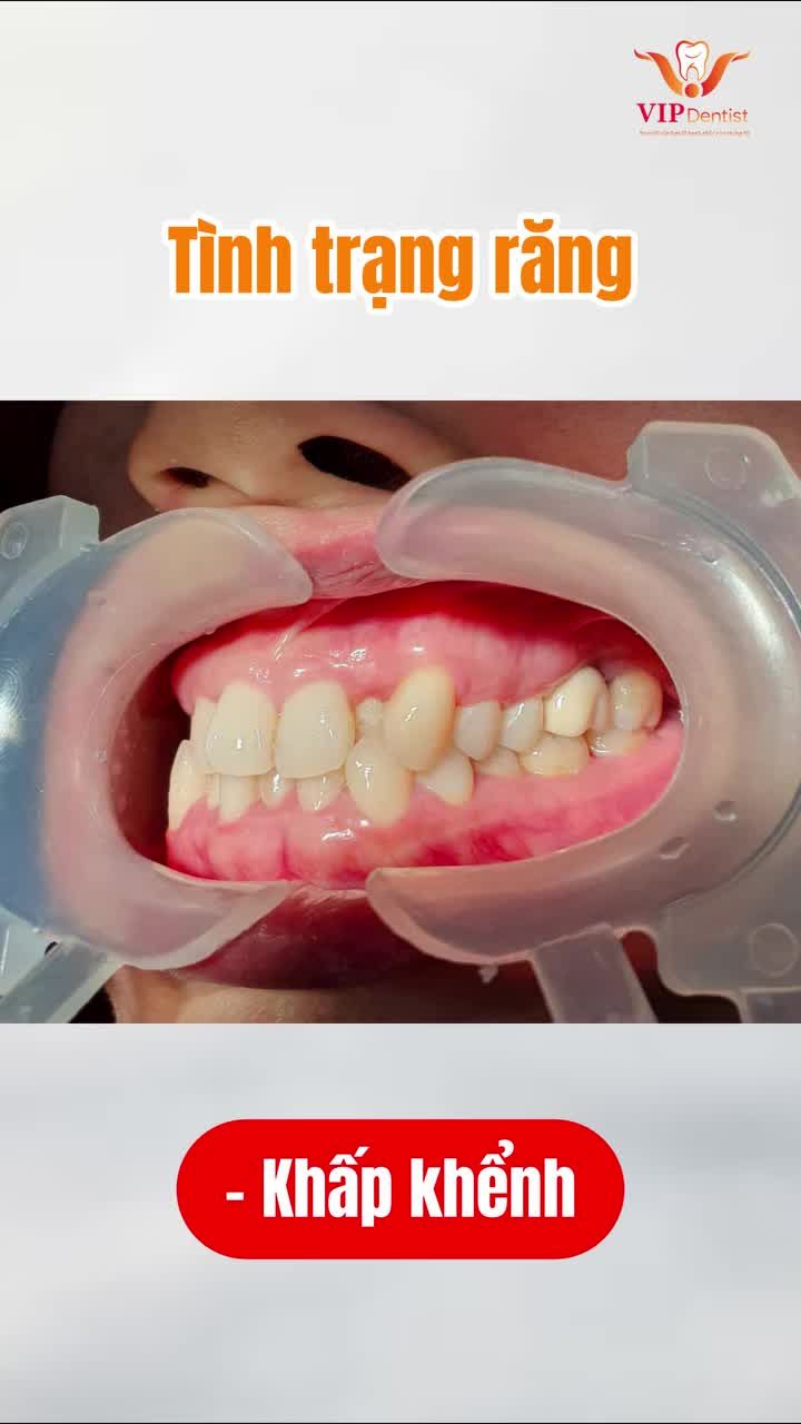 "HÀM RĂNG ĐỀU HƠN - ĐẸP HƠN TRƯỚC RẤT NHIỀU"