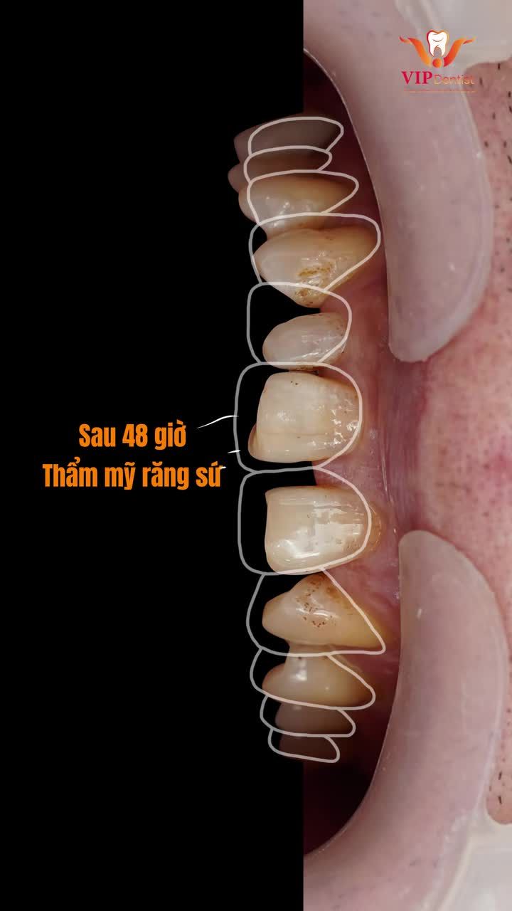 HÔ BIẾN HÀM RĂNG XỈN MÀU, LỆCH LẠC CHỈ SAU 48H