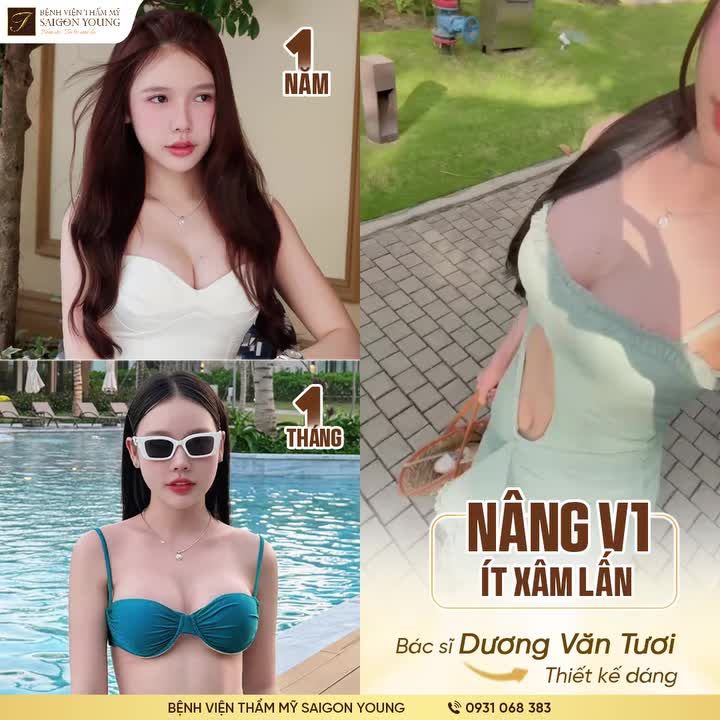 Kỹ thuật nâng V1 ít xâm lấn đỉnh cao từ Bác sĩ Dương Văn Tươi kiến tạo dáng siêu nét và gợi cảm một cách tự nhiên nhất.