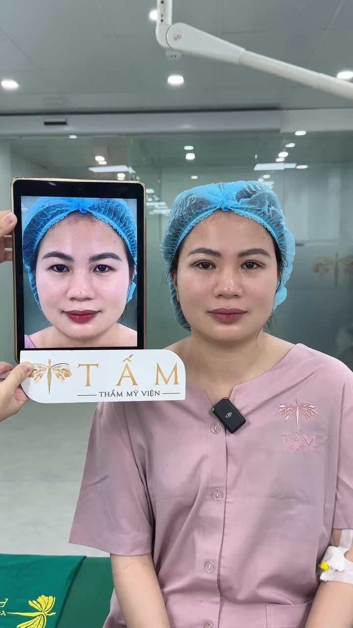 Vượt qua nỗi sợ đau sau 3 lần thăm khám, chị khách cuối cùng cũng quyết định Cắt mí Shanghai tại TMV Tấm và kết quả rất hài lòng sau 45 phút: nếp mí tự nhiên, đều đẹp, gương mặt tươi trẻ hơn.