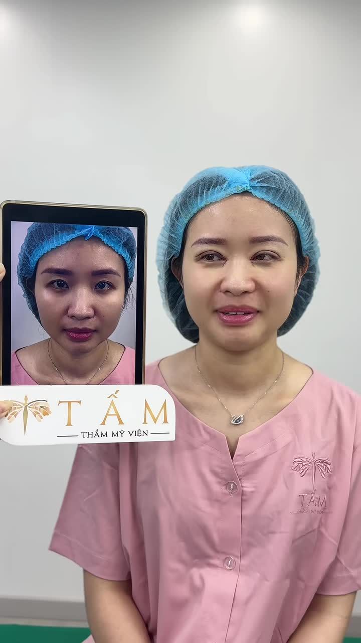 Cùng xem trực tiếp kết quả sau 45 phút của khách hàng làm Combo Cắt mí kết hợp Mở góc trong tại TMV Tấm.