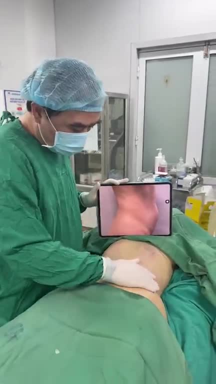 Hút mỡ chuẩn kỹ thuật với Dr Vương: đánh bay mọi tảng/khối mỡ khu trú, cứng đầu kiến tạo bụng eo thon đẹp và vóc dáng tuyệt hảo