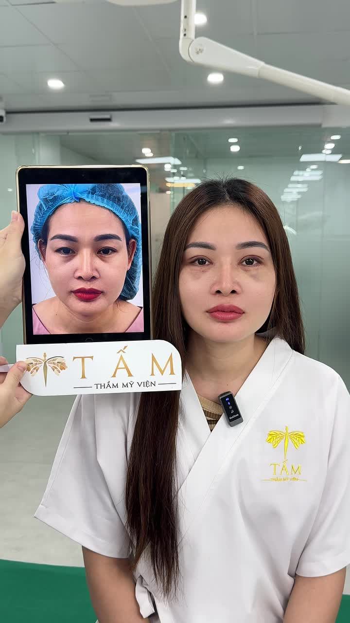 Hình ảnh thực tế khách hàng với cơ địa cực kỳ bầm tím sau 9 ngày quay lại TMV Tấm cắt chỉ