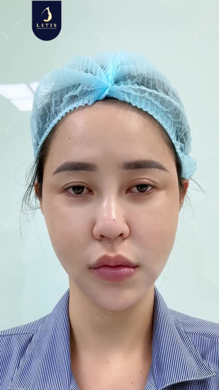 NÂNG CẤP DÁNG MÍ - ĐỔI CẢ ÁNH NHÌN