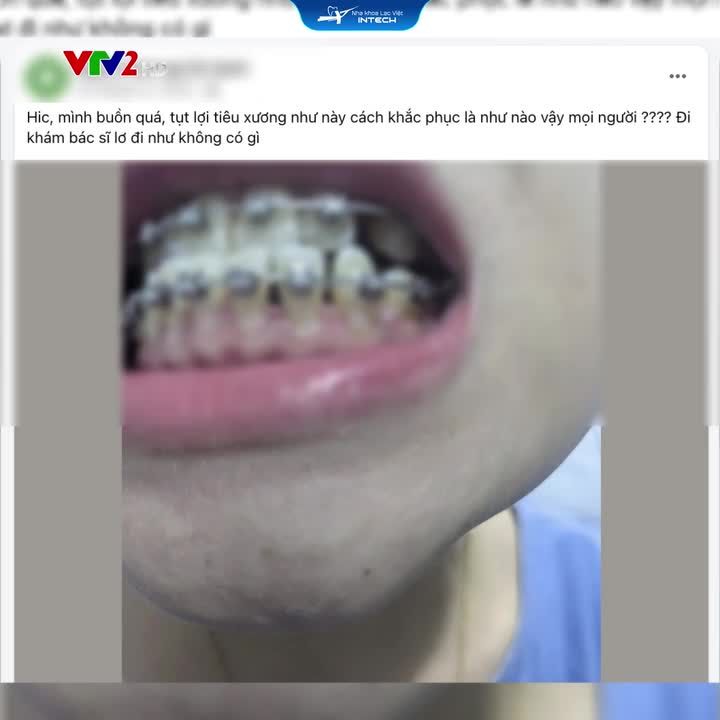 5 BIẾN CHỨNG NIỀNG RĂNG BẠN BẮT BUỘC PHẢI BIẾT TRƯỚC KHI NIỀNG!