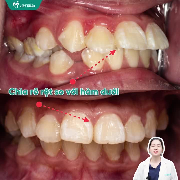 CON BẠN CÓ ĐANG BỊ HÔ, MÓM HAY LỆCH KHỚP CẮN?