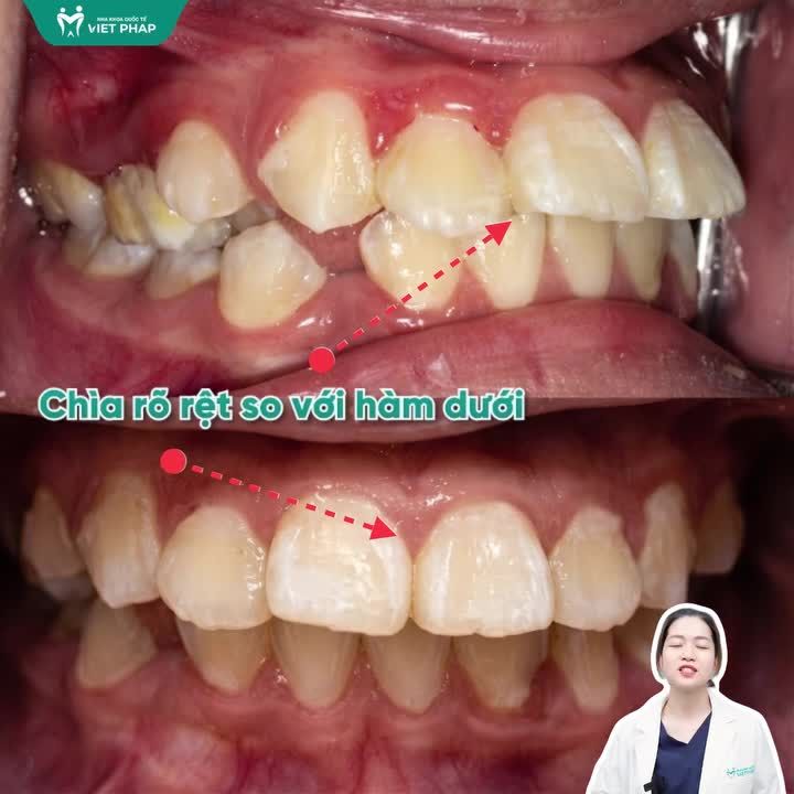 CON BẠN CÓ ĐANG BỊ HÔ, MÓM HAY LỆCH KHỚP CẮN?