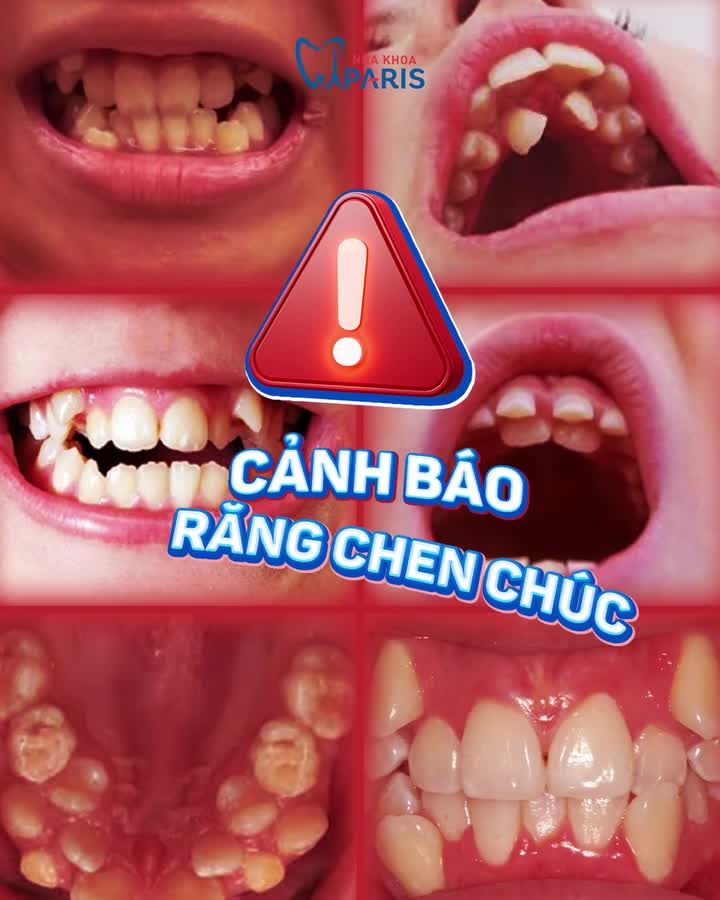 HẬU QUẢ ĐÁNG SỢ KHI BỎ QUA TÌNH TRẠNG RĂNG CHEN CHÚC, MỌC NGẦM Ở TRẺ!
