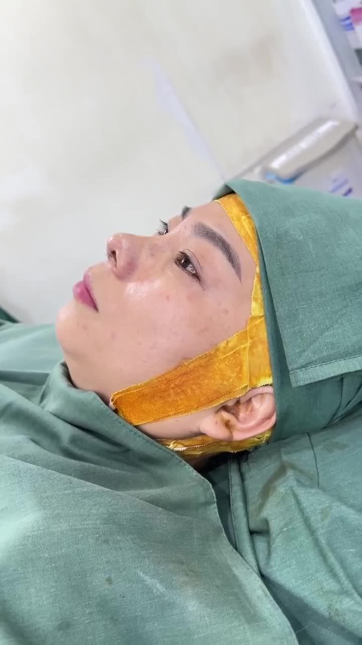 KẾT QUẢ NÂNG MŨI CẤU TRÚC DR. HOẠT