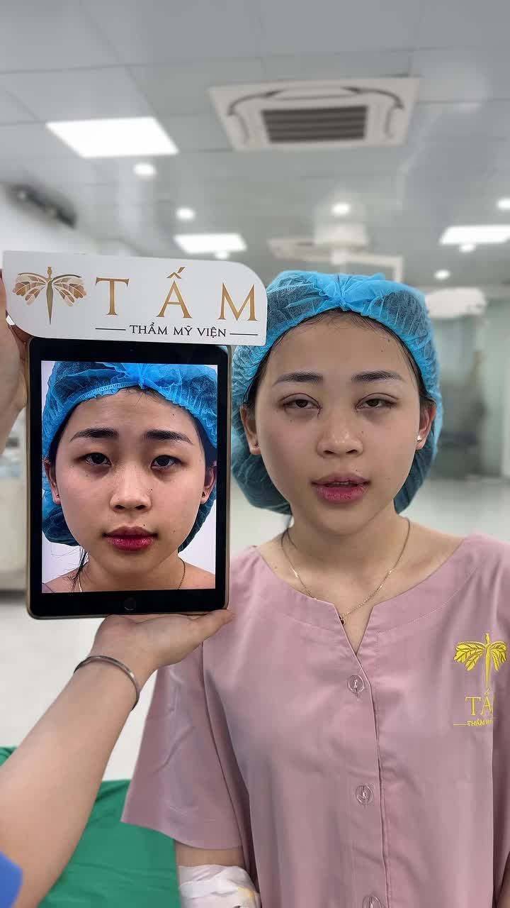 Sau khi thấy chị mình làm xong rất xinh, cô gái 2k7 đến từ Kiên Giang đã quyết định đến TMV Tấm để “nâng cấp” nhan sắc với combo Cắt mí kết hợp mở góc trong  và góc ngoài.