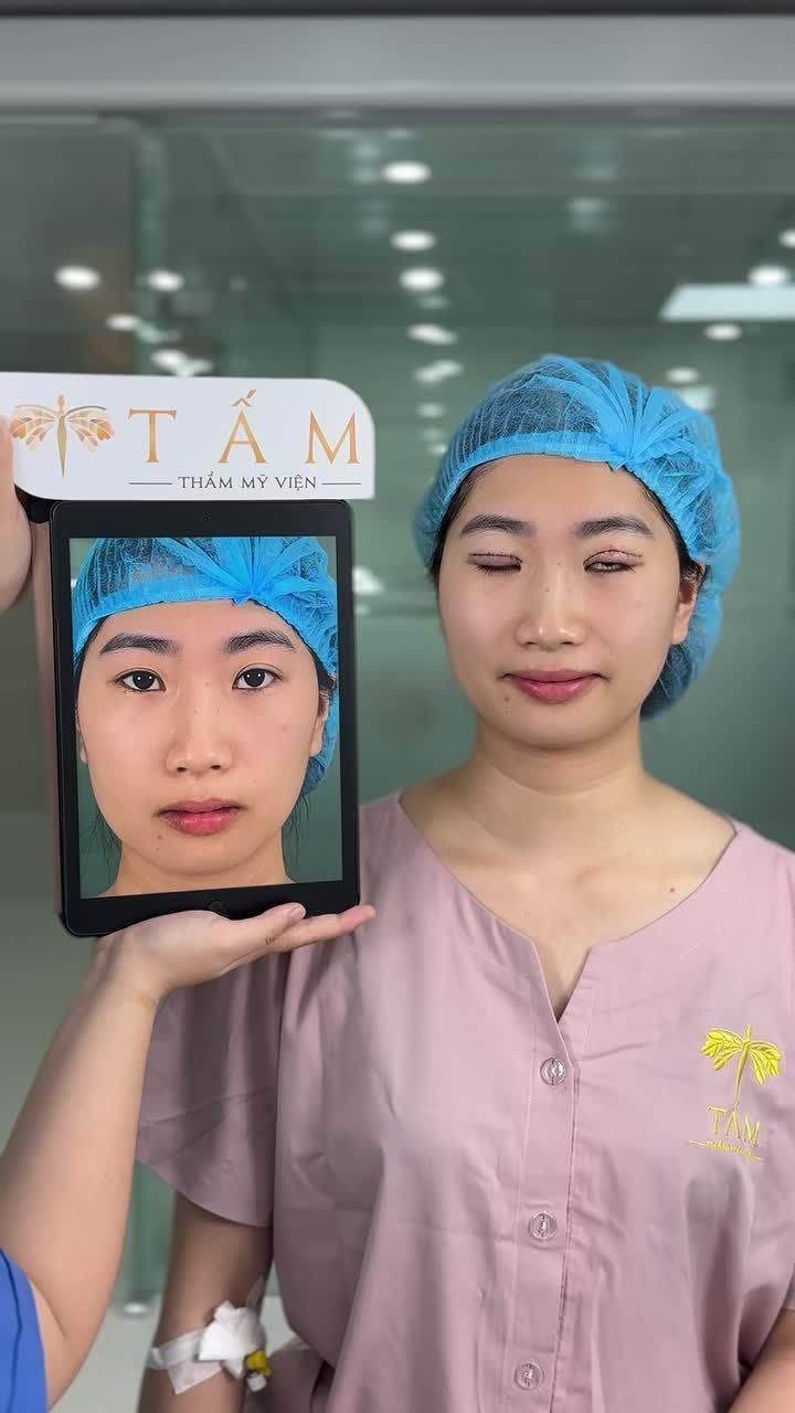 Hình ảnh thực tế của khách hàng sau 30 phút thực hiện Cắt mí Shanghai tại TMV Tấm