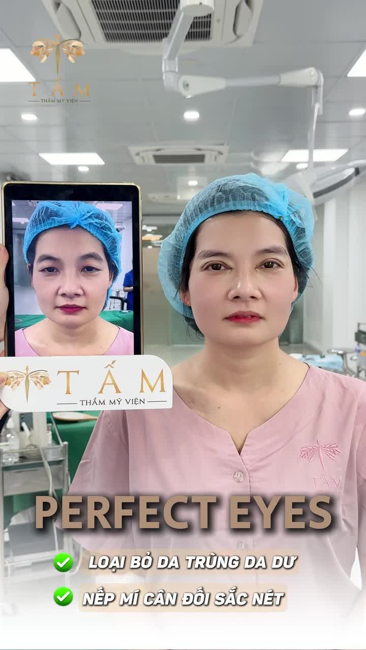 MÍ LÓT, NHIỀU DA TRÙNG, DA THỪA và sự thay đổi ngay sau khi Cắt mí+ Mở góc mắt tại Tấm của chị khách hàng!