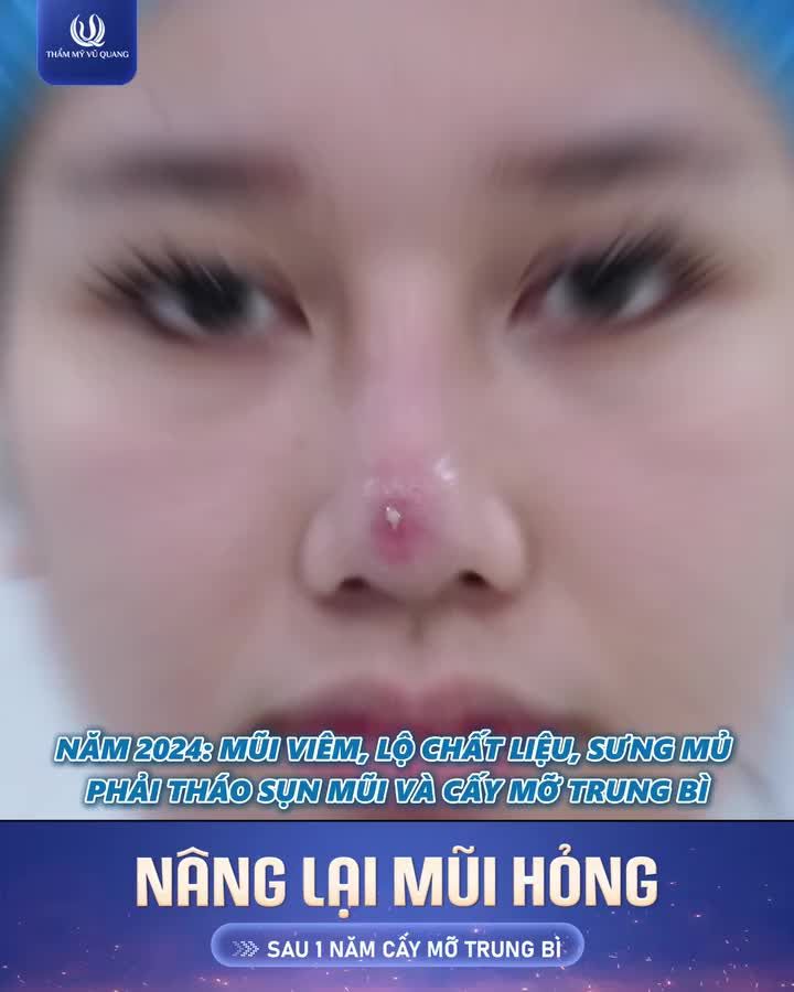 Có những ca mũi hỏng không thể “sửa ngay cho đẹp”… mà cần cả một hành trình để phục hồi lại từ đầu.