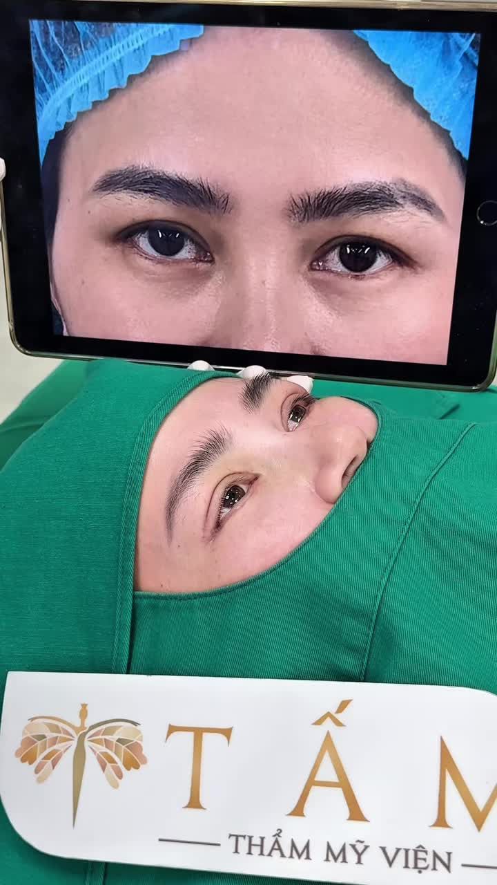 Cùng lắng nghe chia sẻ của chị H đến từ Nam Định, sau khi làm combo cắt mí trên và mở góc mắt ngoài tại Tấm nhé