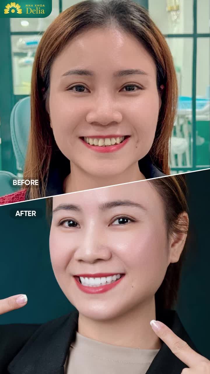 Khách hàng Đinh Thị Phấn hạnh phúc khi kể lại điều đó – sau khi hoàn thiện nụ cười tại Delia.