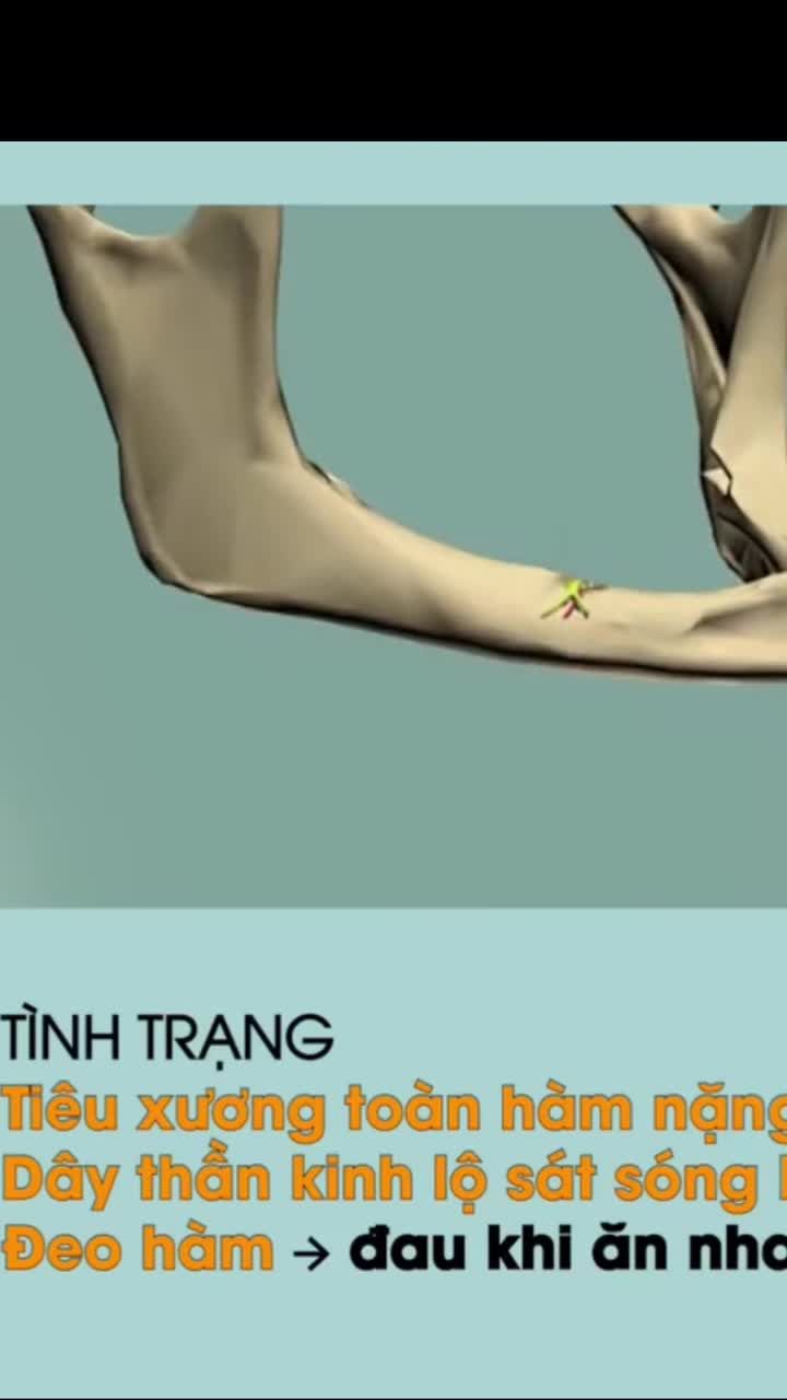 Mất răng lâu năm, tiêu xương nhiều… liệu còn làm được không?