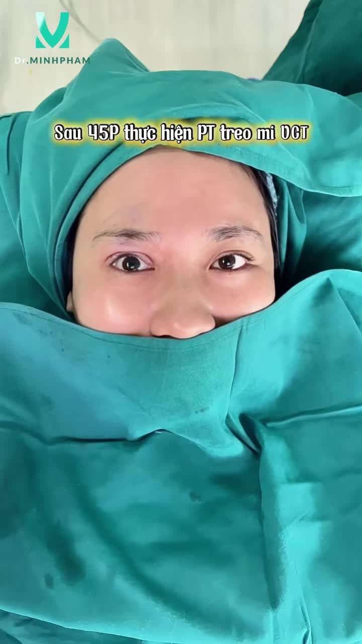 Khách hàng trước khi đến với Dr. Minh Phạm có tình trạng sụp mi mắt phải