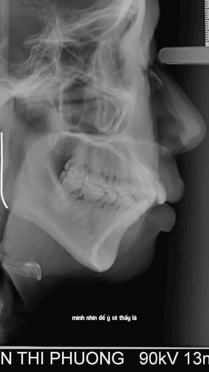 Góc đóng, cằm không được đẹp. Niềng làm sao ? Thế nào cho được?