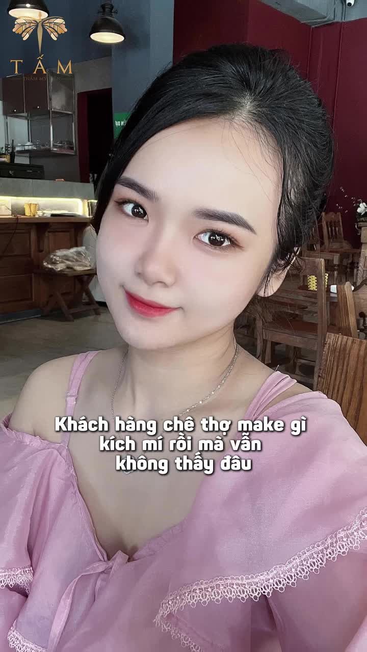 Khách hàng từng tự ti vì mắt nhiều da dư và bọng mỡ phì đại.