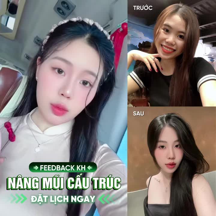 Đẹp hết nước chấm với dáng mũi cấu trúc của nàng thơ BV PTTM Ngô Mộng Hùng!