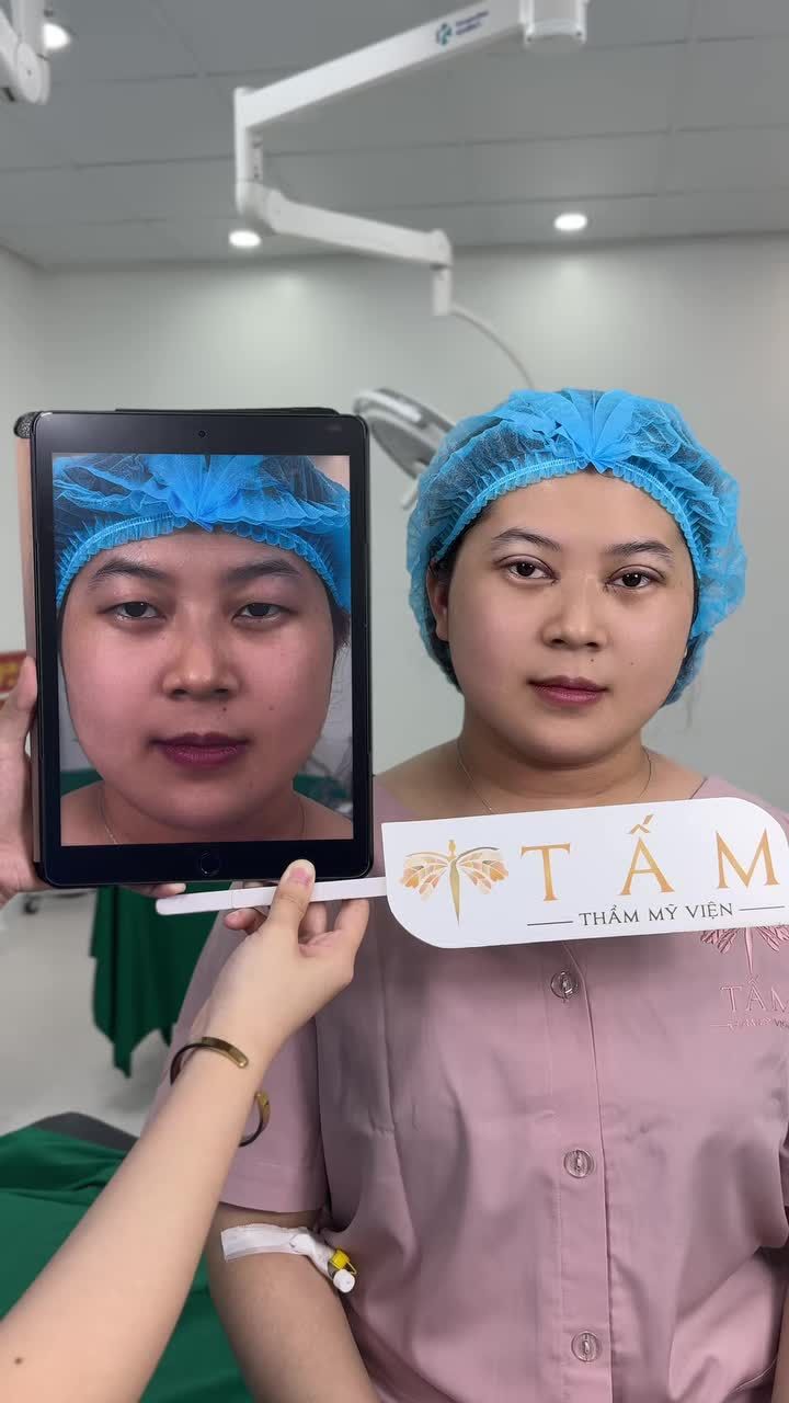 Hình ảnh trực tiếp khách hàng làm Combo Cắt mí kết hợp mở góc trong tại TMV Tấm.