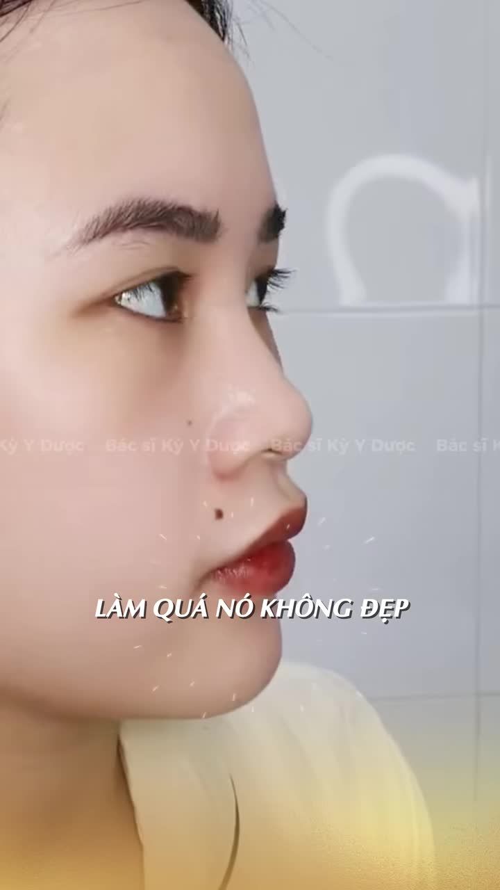 Nâng mũi như thế nào là vừa đẹp Chính tay Bác sĩ Kỳ - Giảng viên Đại học Y Dược TP.HCM thực hiện