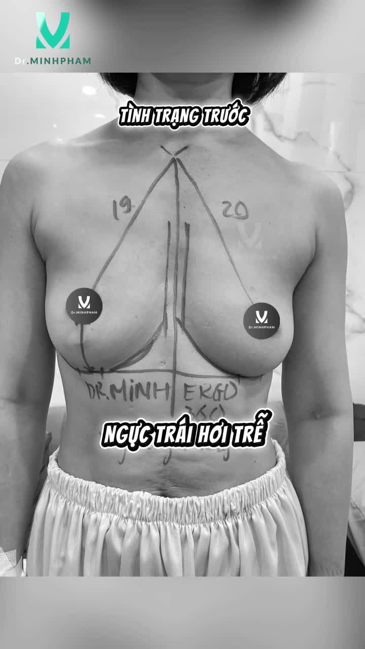 Tái sinh vòng 1 "căng tròn" với túi ERGO size 335cc
