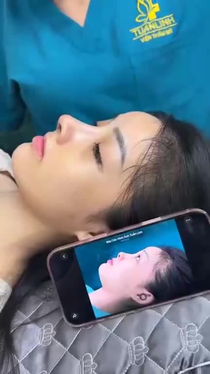 MŨI CẤU TRÚC SURGIFORM SAU 12 NGÀY – VỪA XINH VỪA TỰ NHIÊN