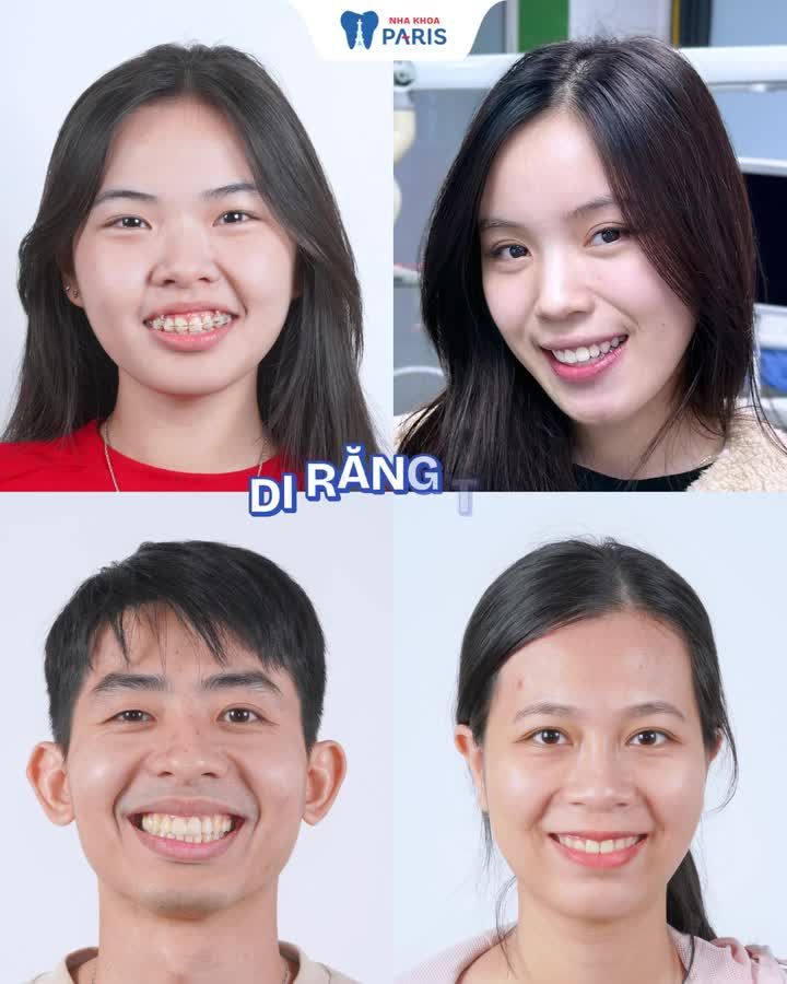 THỜI GIAN KHÔNG CÒN LÀ RÀO CẢN: NIỀNG RĂNG NHANH - RÚT NGẮN ĐẾN 8 THÁNG!