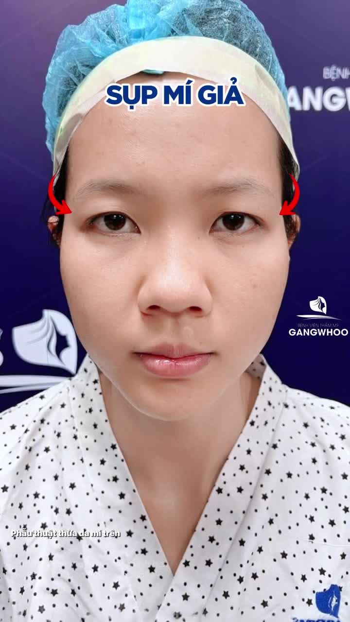 Sụp mí có nên cắt mí không? Không phải trường hợp nào cũng giống nhau. Bác sĩ sẽ giải đáp 2 nguyên nhân thường gặp và cách chọn đúng giải pháp để tối ưu kết quả.