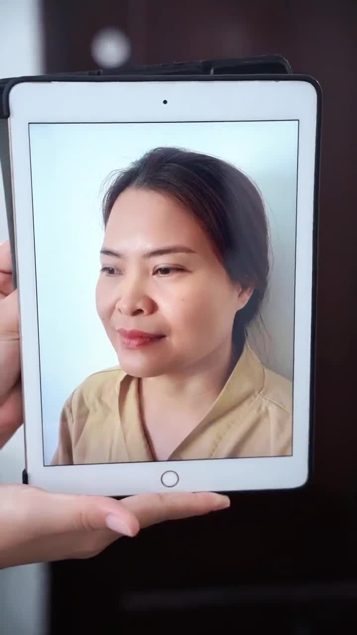 KẾT QUẢ NÂNG MŨI CẤU TRÚC SAU 2 TUẦN KH. CAO T. MAI