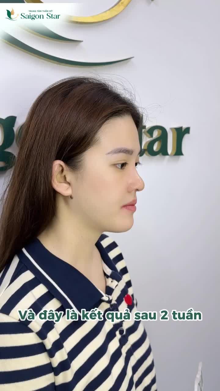NÂNG MŨI CẤU TRÚC DR. HOẠT - KIẾN TẠO GÓC NGHIÊNG ĐẸP NHƯ Ý!!