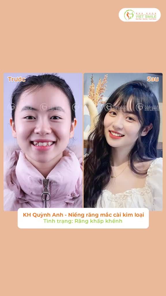 Flex 5 ca "Lột xác" sau niềng răng khấp khểnh tại Viet Smile