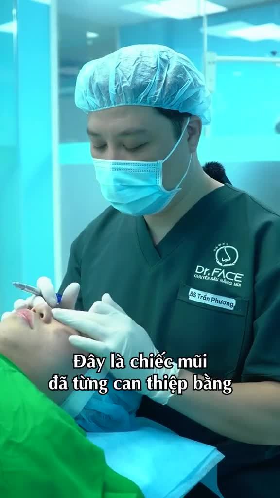 Khi chạm vào mũi, bs vẫn cảm nhận còn filler bên trong. Hướng xử lý trong ca này là loại bỏ filler và vẫn nm trong cùng 1 ca.