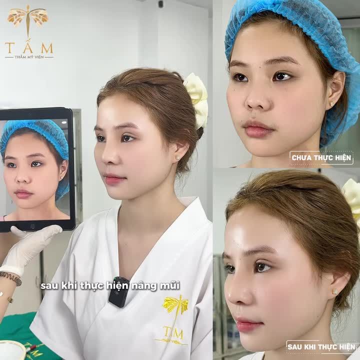 Cắt mí - Nâng mũi tại Tấm, loại bỏ mọi khuyết giúp bạn thăng hạng nhan sắc "tức thì"