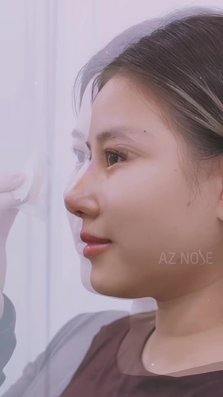 Khác biệt giữa 2 thời điểm "vừa tháo nẹp" và "sau 2 tháng" là gì?