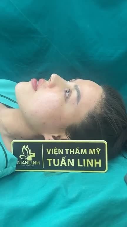 NÂNG MŨI BỌC SỤN VỪA HOÀN THÀNH – KHỞI ĐẦU CHO HÀNH TRÌNH NHAN SẮC MỚI