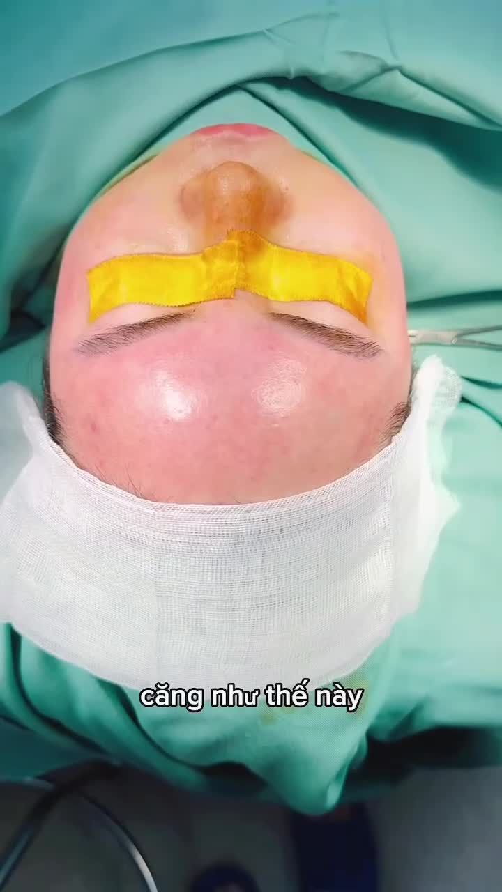 KHI GƯƠNG MẶT “THIẾU MỘT CHÚT ĐẦY ĐẶN” – CẤY MỠ TỰ THÂN LÀ LỰA CHỌN RẤT ĐÁNG CÂN NHẮC