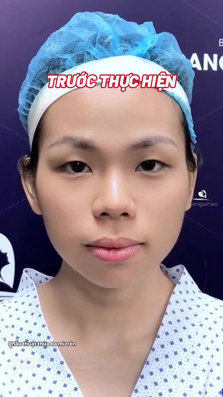 Cắt mí nhẹ nhàng, không đau, kết quả tự nhiên và hồi phục nhanh chóng.