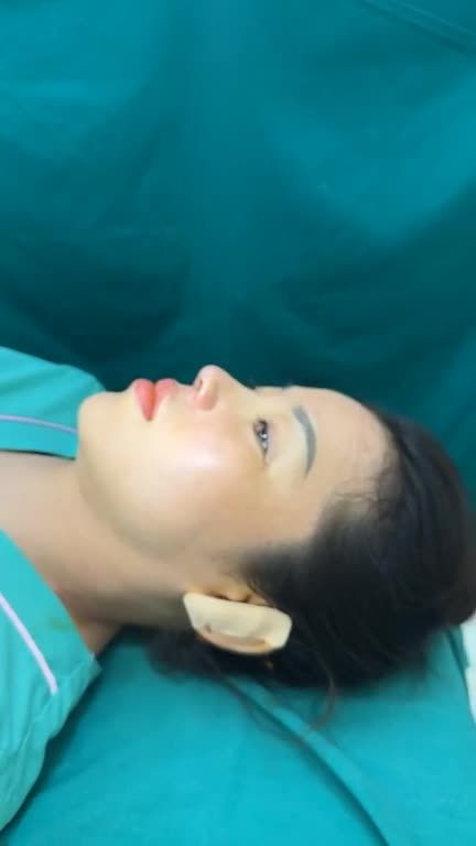 Mũi cấu trúc sửa lại surgiform