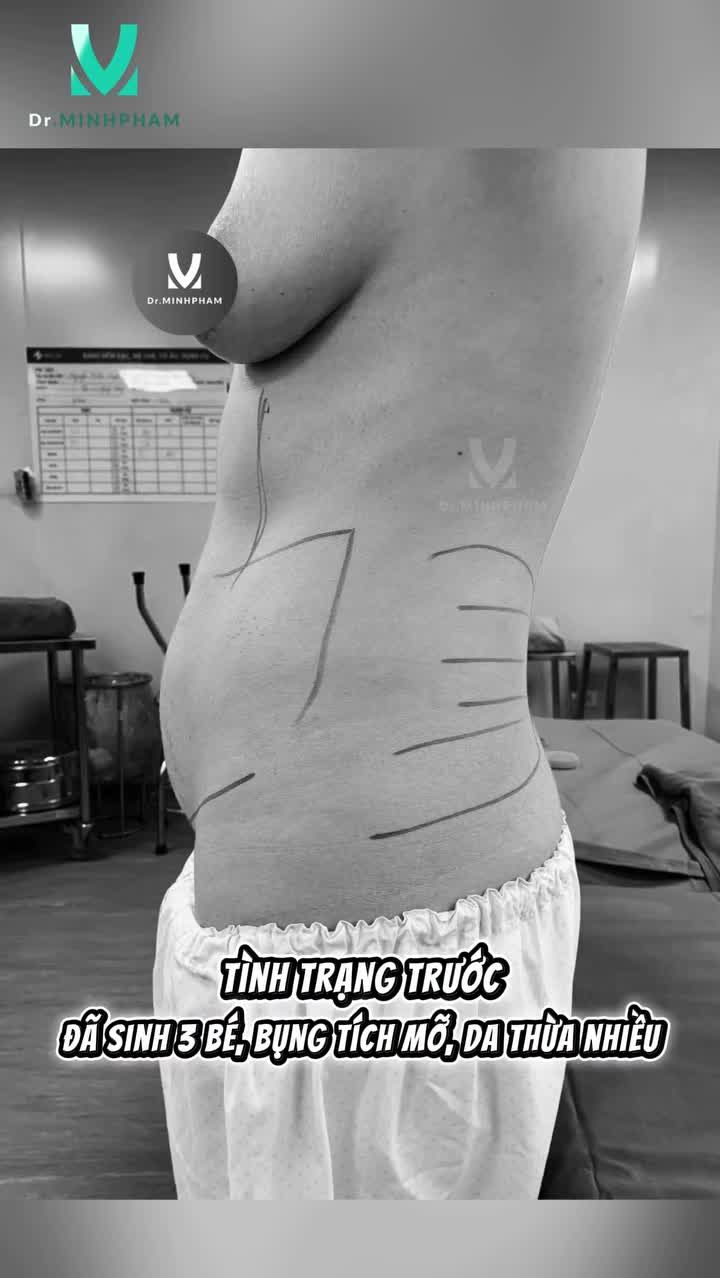Chị khách 45 tuổi, nặng 60kg cao 1m58 đã sinh 3 bé nên vòng bụng lên tới 90 cm.