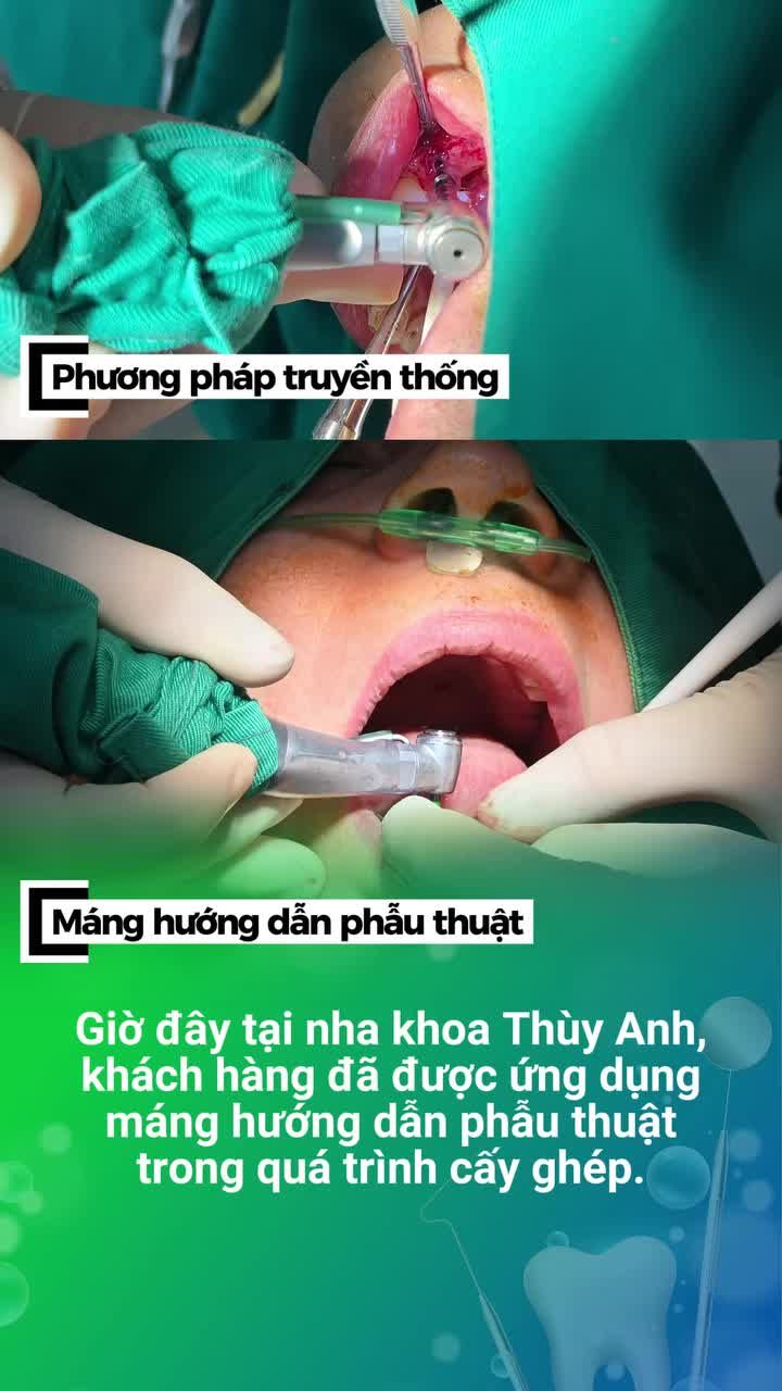 BÁC SĨ NHA KHOA THUỲ ANH NÓI GÌ VỀ MÁNG HƯỚNG DẪN PHẪU THUẬT?