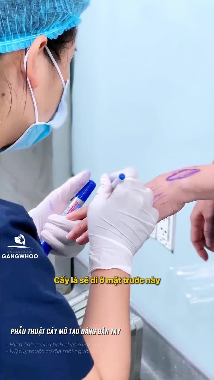Vì sao nên cấy mỡ bàn tay ở mặt trước?