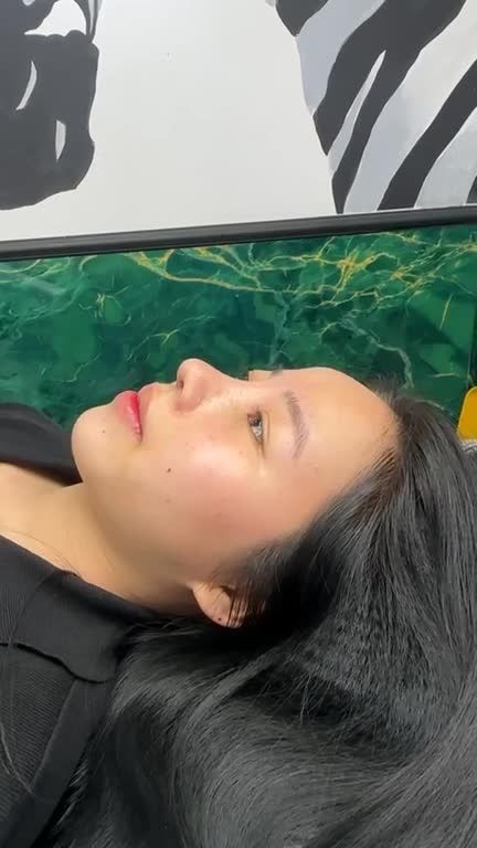 Mũi nâng cấu trúc sau 10 ngày