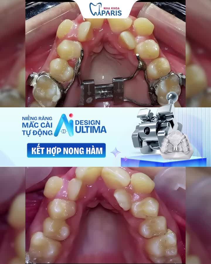 NIỀNG RĂNG KẾT HỢP NONG HÀM – GIẢI PHÁP TỐI ƯU HẠN CHẾ NHỔ RĂNG