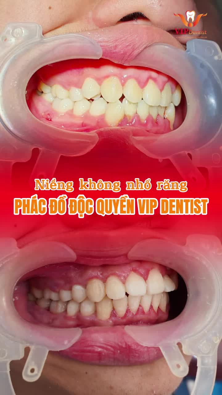 Điều trị dứt điểm răng khấp khểnh - dẫn tới bệnh lý viêm lợi với phương pháp niềng không nhổ răng