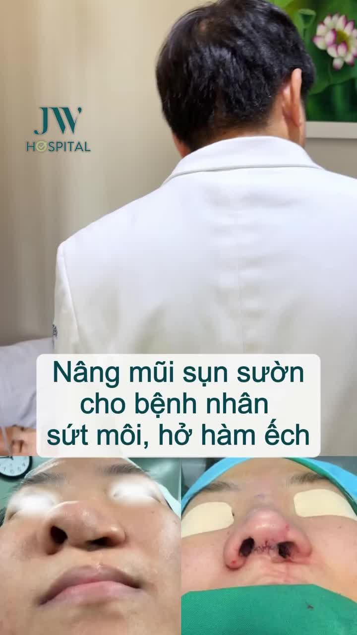BÁC SĨ TÚ DUNG NÂNG MŨI SỤN SƯỜN, LẤY LẠI SỰ TỰ TIN CHO EM GÁI DỊ TẬT HỞ HÀM ẾCH BẨM SINH