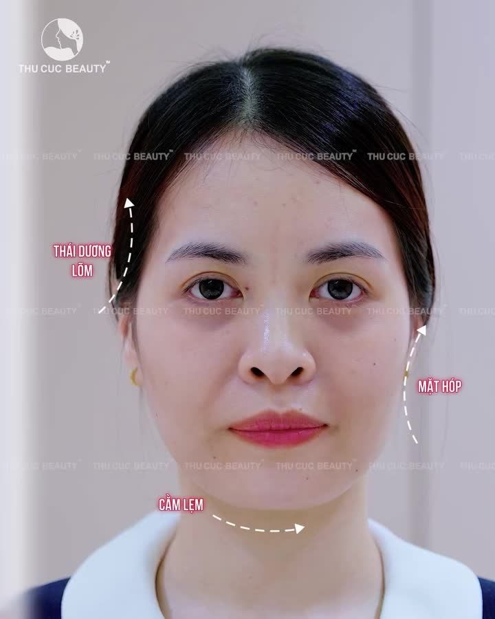 CĂN CHỈNH TỶ LỆ VÀNG FULLFACE - ƯU ĐÃI CHỈ 3TR/CC