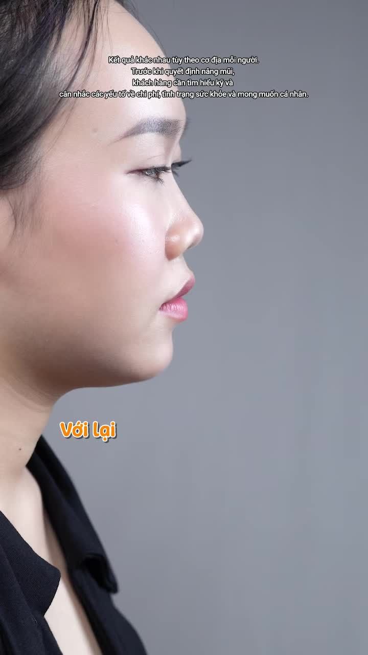 Quyết tâm thay đổi phong thuỷ với dáng mũi mới, nhân viên kinh doanh GenZ khiến đồng nghiệp bất ngờ vì diện mạo như "thay đầu" sau 2 tháng nâng mũi cấu trúc!