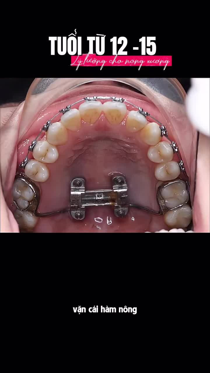Niềng răng có giúp bé nhà bạn hạn chế thở bằng miệng không ?  Cùng xem chia sẻ của bs tại nha khoa để biết thêm nhé